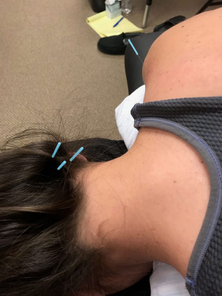 Dry Needling Therapy  (DNT) Frequently Asked Questions