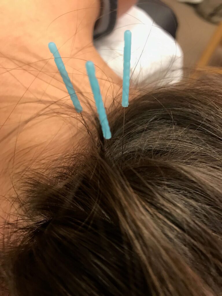 Is dry needling therapy right for you?