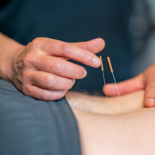 dry-needling-TFI-physical-therapy-Chicago-Vernon-hills-IL