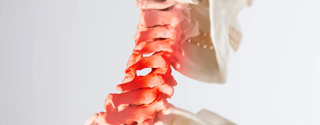 Whiplash Treatment: Managing Neck Injuries After a Car Accident